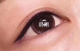 半永久纹美瞳线前后期对比照片
